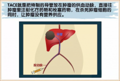  TACE和HAIC到底是什么？