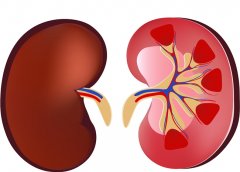 肾小球肾炎怎么检查出来，患者留意症状也重要