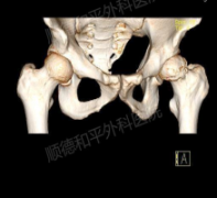 保髋治疗：为年轻患者守护“原生家园”